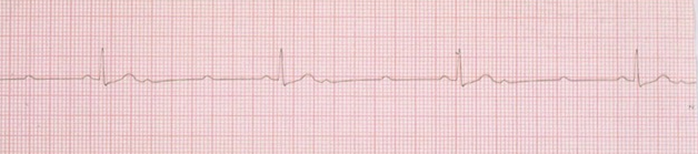 AV block