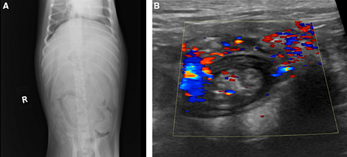 colonic-hamartomatous-ganglioneuromatosis.jpg
