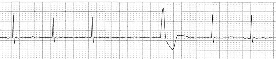 Ventricular escape beat