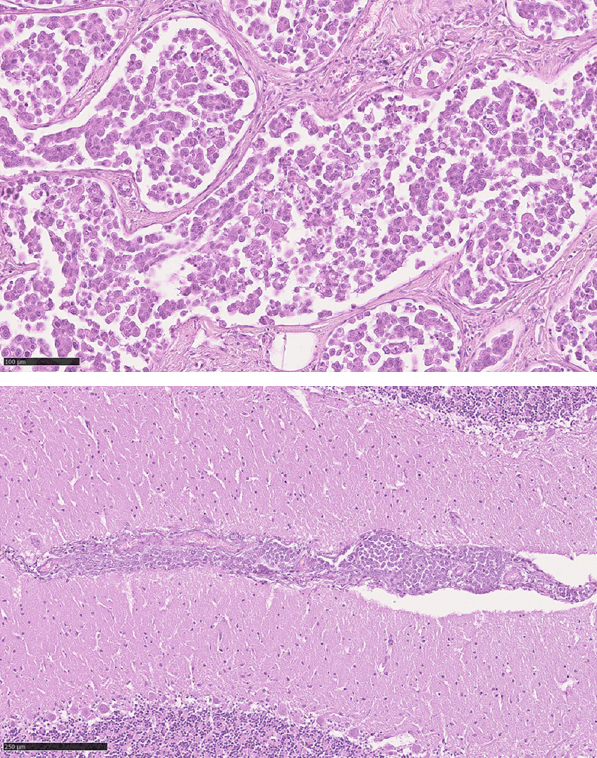 Leptomeningeal-Carcinomatosis.jpg