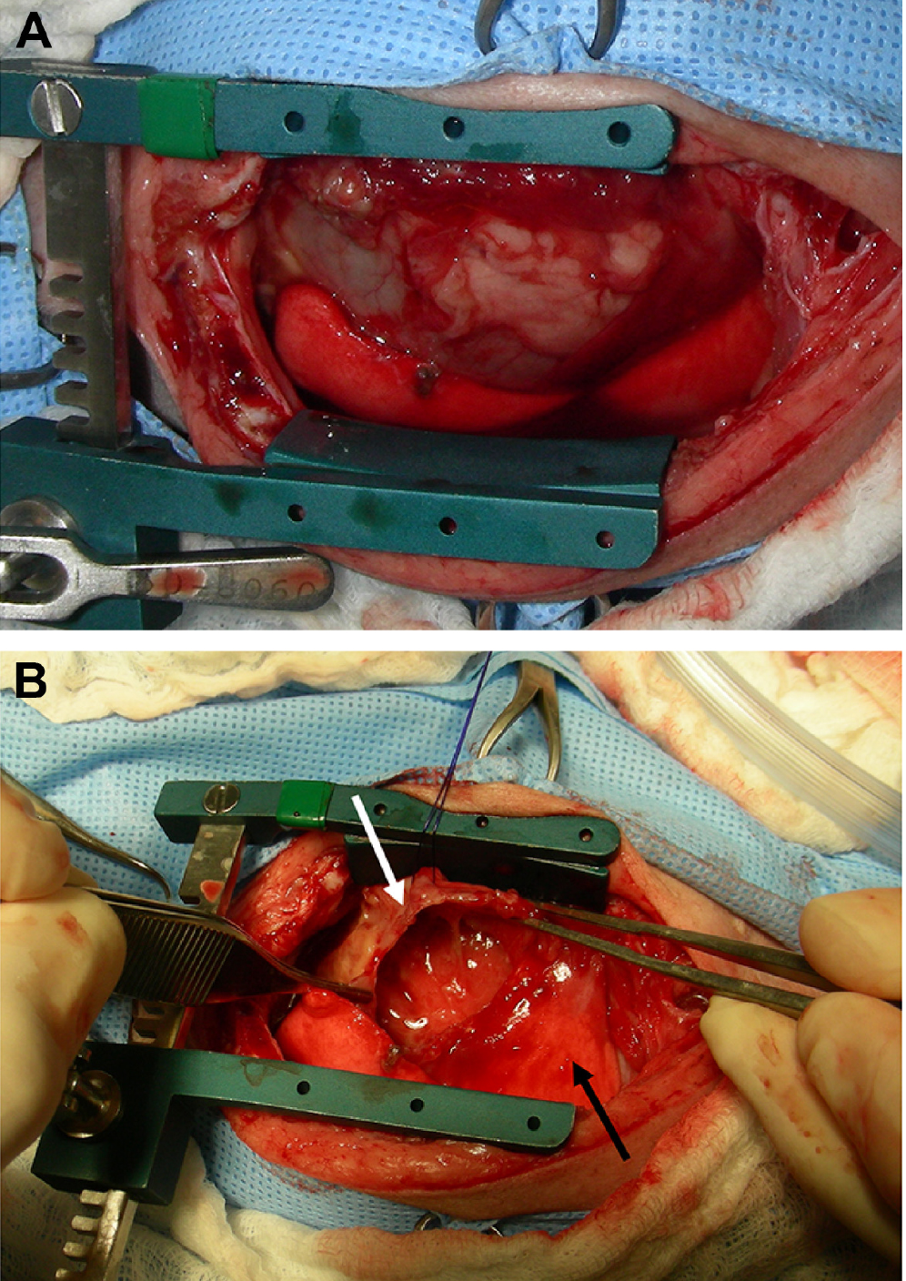 Pericardiectomy.jpg