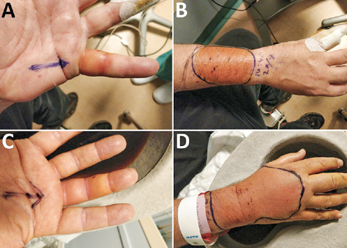 Man's hand after a bite from a stray cat