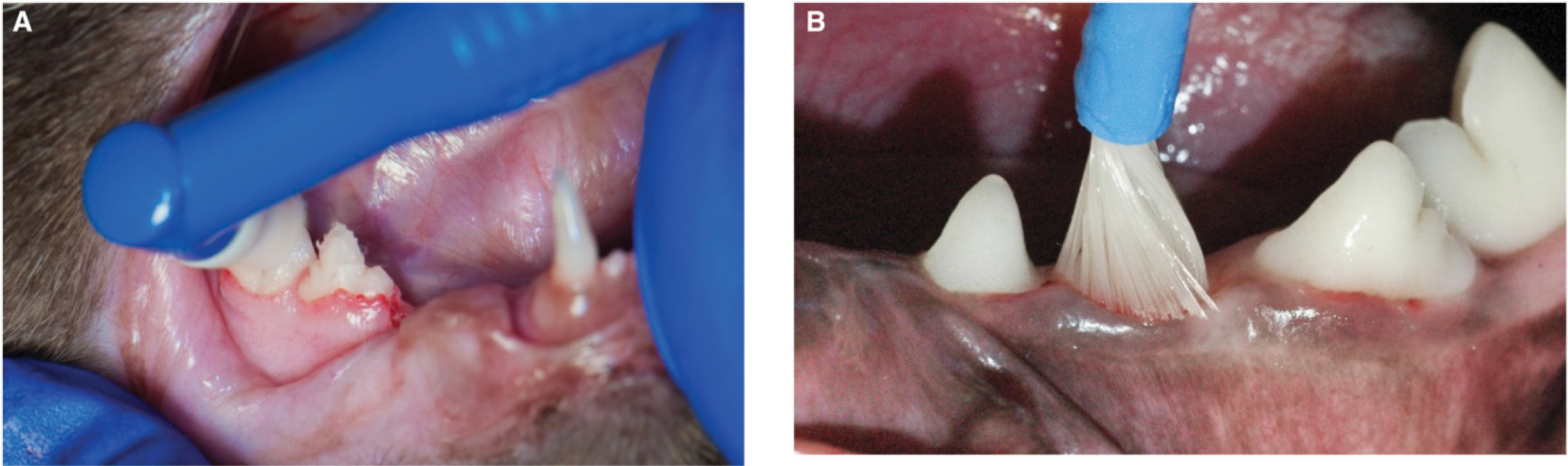 Image of applying antiplaque sealants