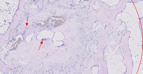 Microscopic view of a mast cell tumor