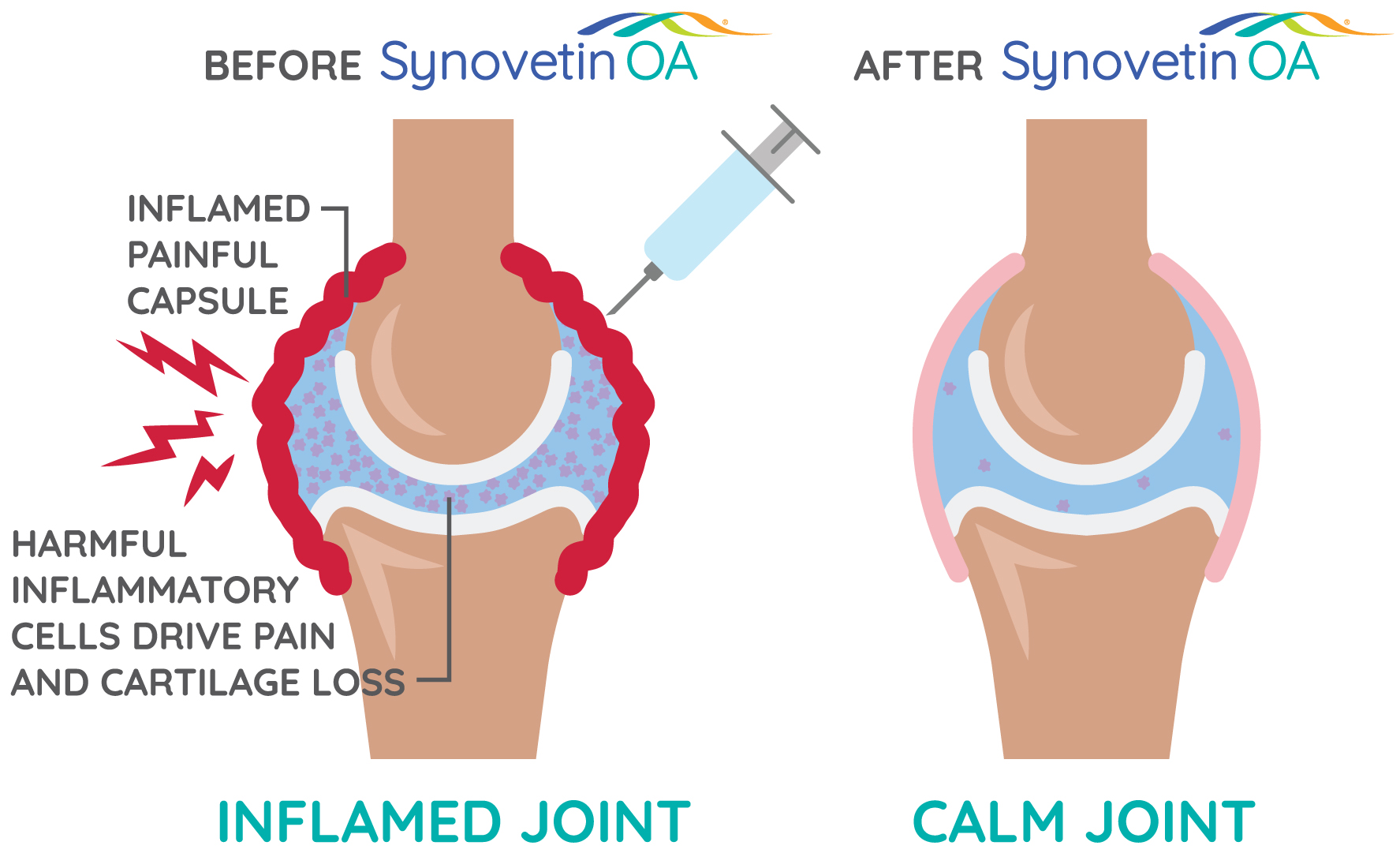 Diagram: Microscopic radiotherapeutic particles are injected directly into the joint where they safely deactivate the inflammatory cells that are causing pain, destroying cartilage, and driving disease progression.6‑8